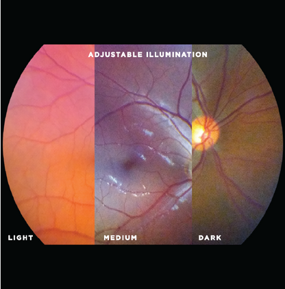 VistaView™ Mydriatic Portable Fundus Camera