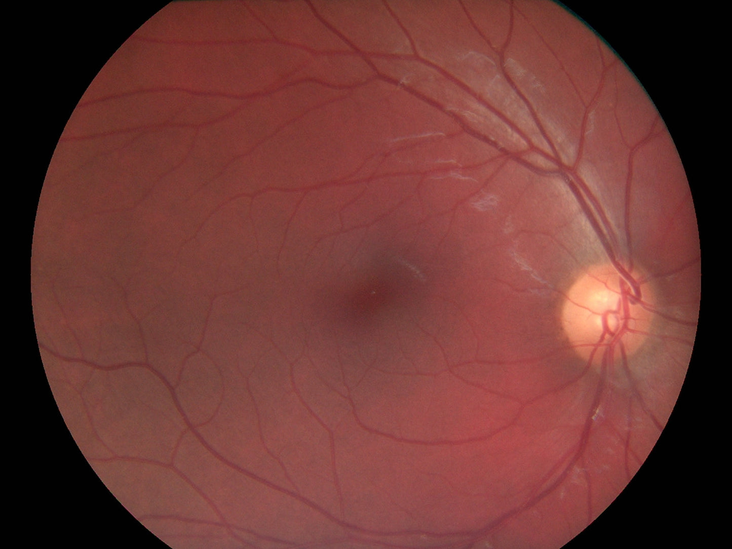 Pictor Plus™ Fundus Camera