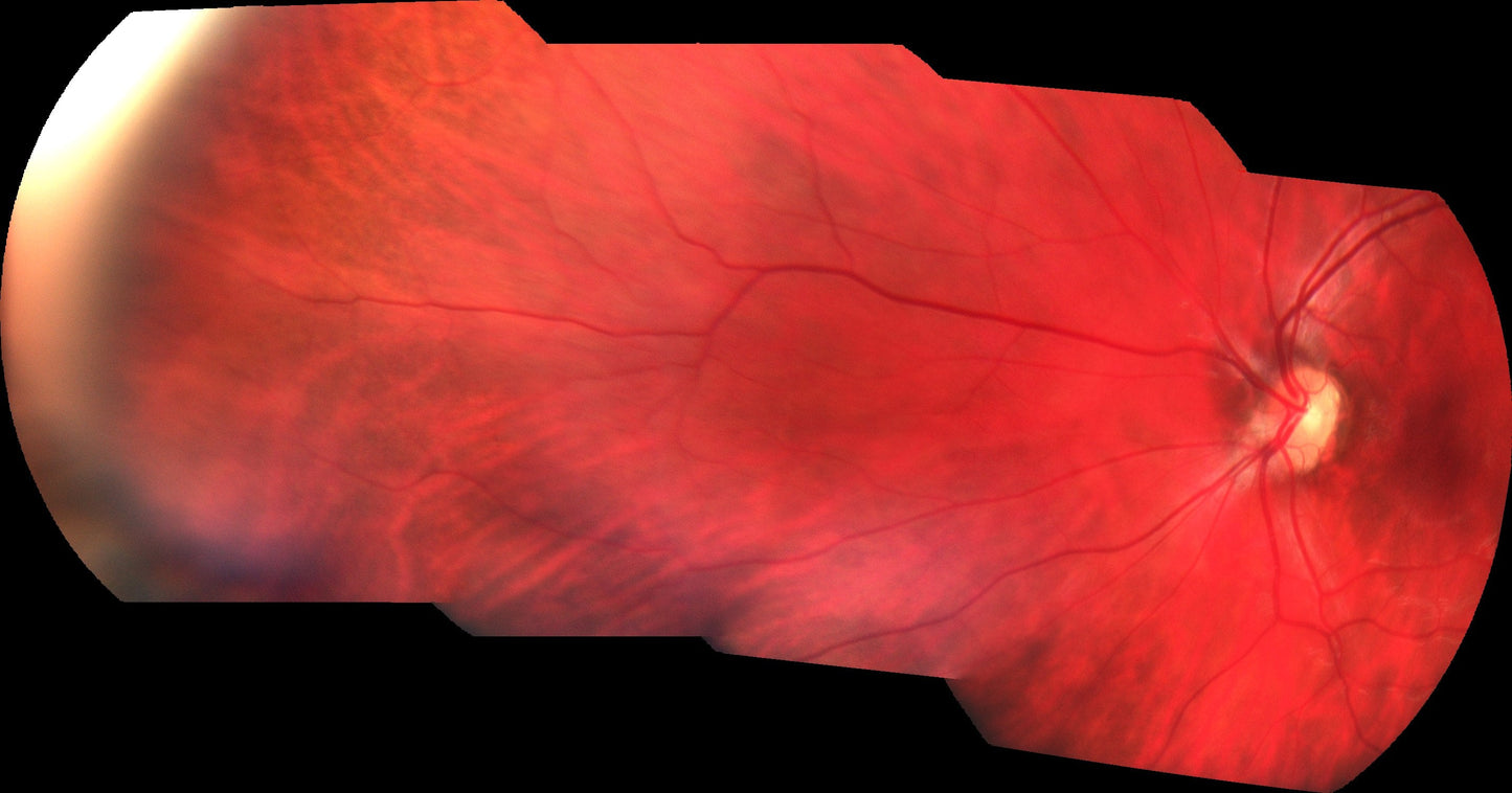 Pictor Plus™ Fundus Camera