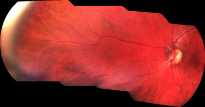 Pictor Plus™ Fundus Camera