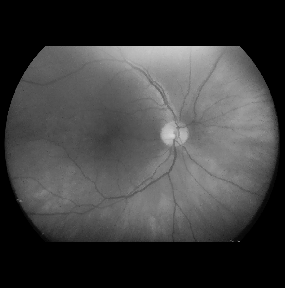 VistaView™ Mydriatic Portable Fundus Camera